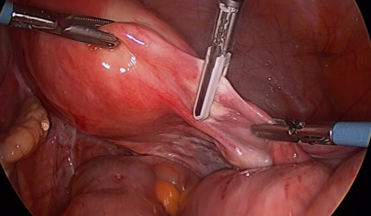 Histerectomia: procedimento de retirada de útero demanda avaliação médica e cuidados diversos, inclusive por equipes multidisciplinares