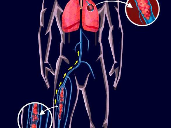 Tromboembolismo Venoso – Conheça as formas e impactos da condição grave no sistema circulatório