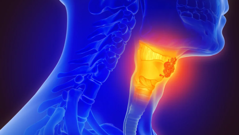 Diagnóstico precoce é fundamental para o controle do câncer de cabeça e pescoço